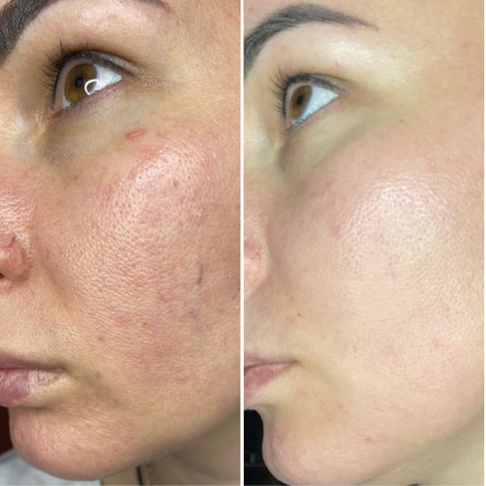 Результат работы косметолога Юлии Кащеевой